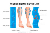realistic varicose veins anatomy infographics.jpg
