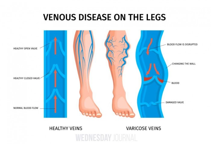 realistic varicose veins anatomy infographics.jpg