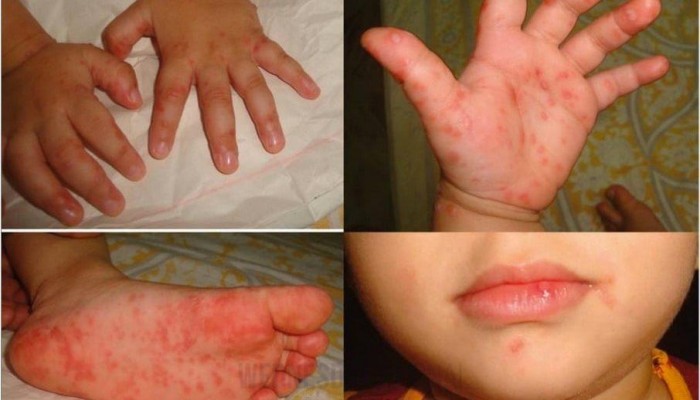 홍콩, 수족구병 한 달간 78건 발생…학교에 큰 타격.jpg