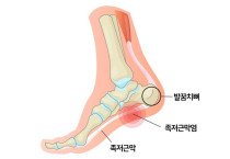 족천근막염과 발바닥 통증의 이해: 홍콩 카이로프랙틱 전문의가 전하는 가이드 [칼린 박사 건강칼럼]