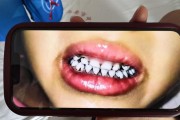 中서 유치원생 20여명 '납중독 파문'…머리 빠지고 치아 까매져