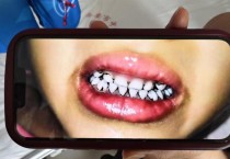 中서 유치원생 20여명 '납중독 파문'…머리 빠지고 치아 까매져