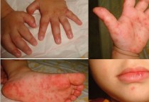 홍콩, 수족구병 한 달간 78건 발생…학교에 큰 타격