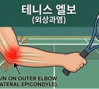 팔꿈치 통증? 골프 엘보와 테니스 엘보의 차이점 - [칼린 박사 건강칼럼]